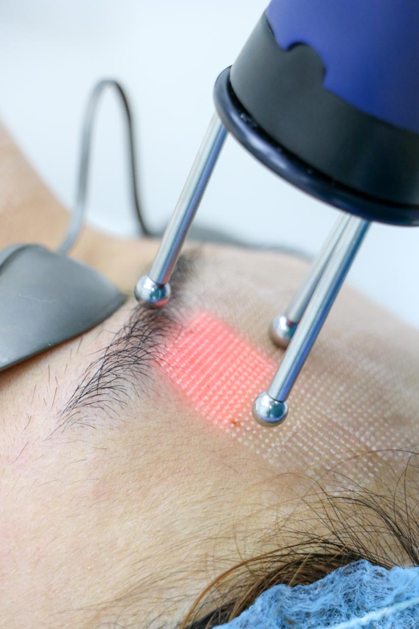 Laser Treatment
